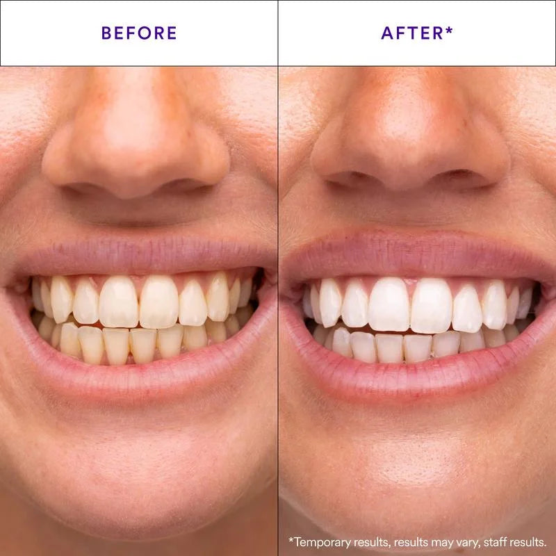 Purple Teeth Whitening Strips
