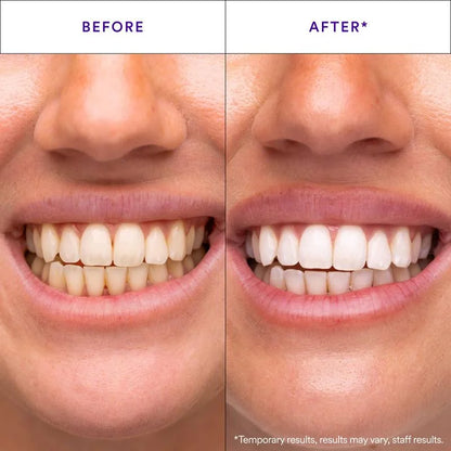 Purple Teeth Whitening Strips